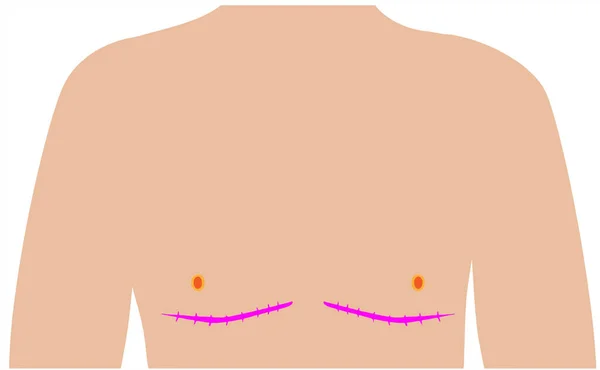 Normal Breast Stock Illustrations – 80 Normal Breast Stock
