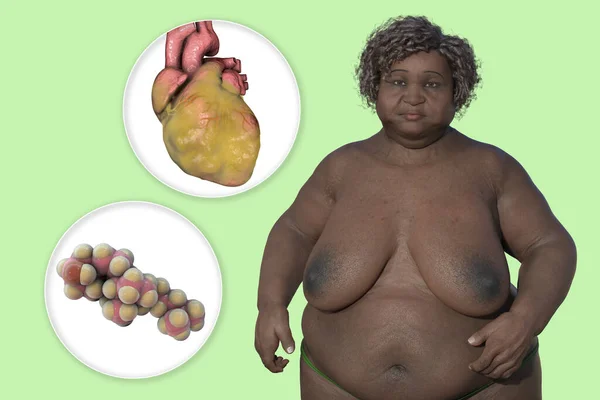 Molécula Colesterol Corazón Obeso Mujer Con Sobrepeso Ilustración Concepto Obesidad — Foto de Stock