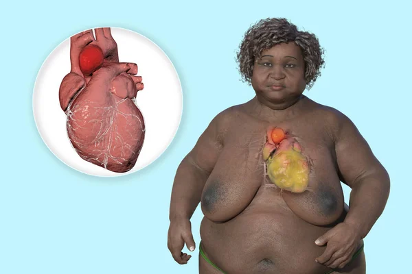 Vědecká Ilustrace Zobrazující Obézní Ženu Průhlednou Kůží Odhalující Vzestupné Aortální — Stock fotografie