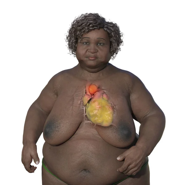 透明な肌を持つ肥満の女性を描いた3D科学的イラスト 上昇する動脈瘤を明らかにする 肥満の動脈上昇の関連性を強調する概念 — ストック写真