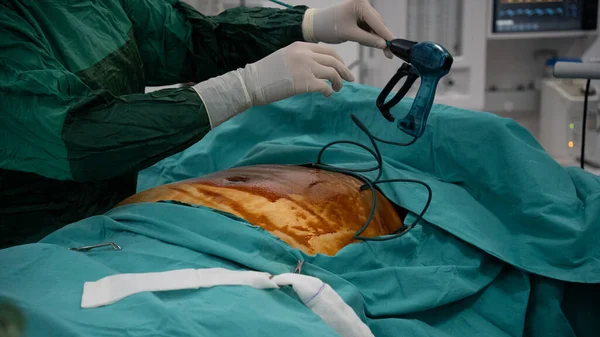 Elhízás Műtét Elhízás Műtétre Készülő Műtét Előtt Sterilizálják Sebészeti Területet — Stock Fotó