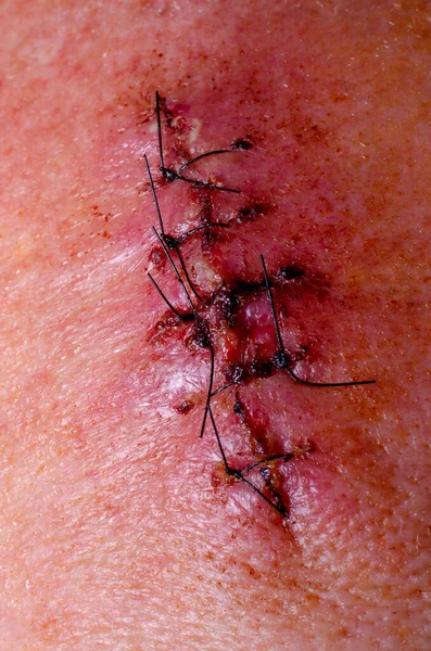 Surgical stitches in a wound - Stock Image - C047/3874 - Science Photo  Library